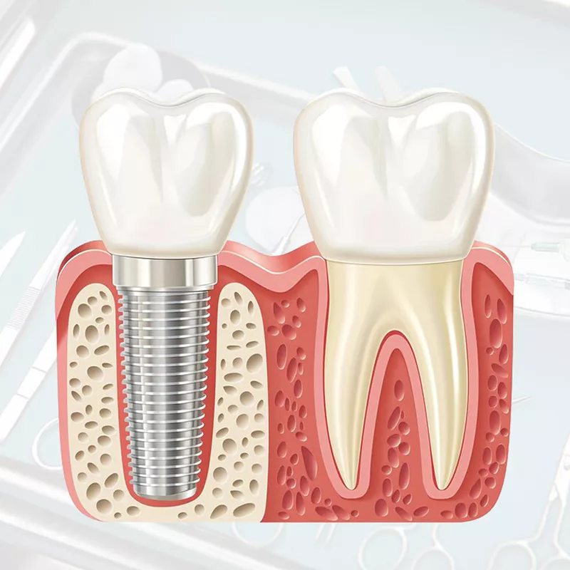 Cấy Ghép Implant Nha Khoa Hiện Đại