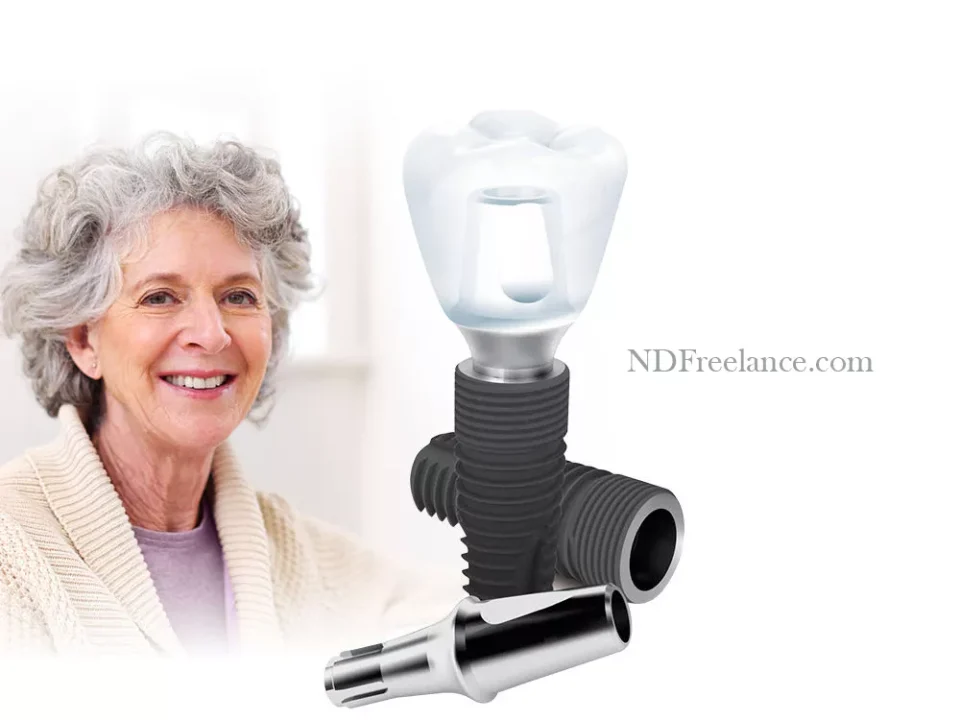 cấy ghép implant nha khoa